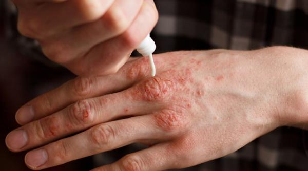 psoriazisul mai mult decat o boala de piele