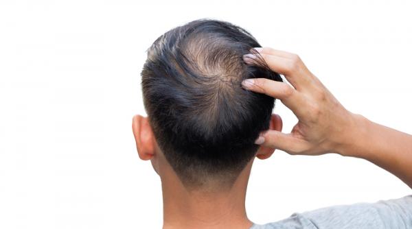 stopeaza caderea parului cu ajutorul medicamentelor antiandrogenice