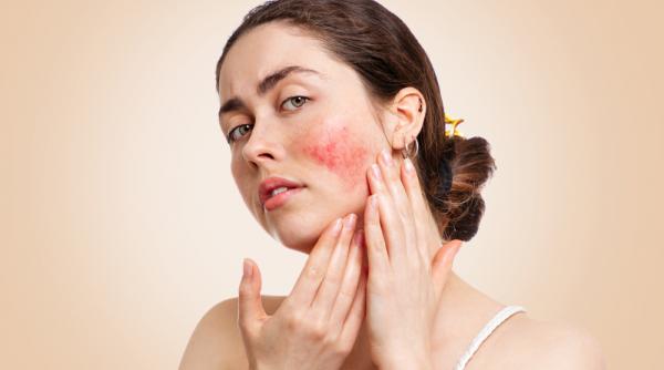 tenul cuperozic ce este si cum il ingrijesti