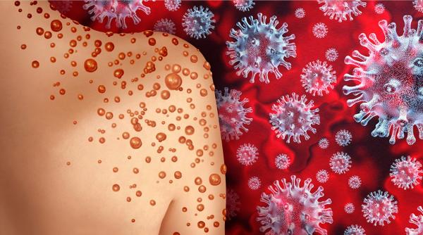 avertisment oms variola maimutei a fost declarata urgenta sanitara globala