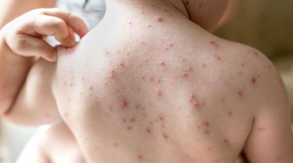 oms 72 de copii printre cele peste 17 000 de cazuri de variola maimutei