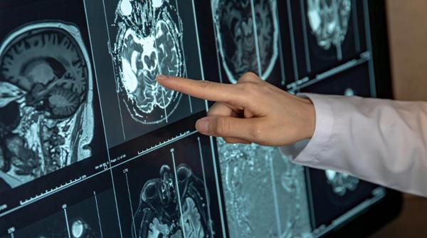 inteligenta artificiala depistare precoce cancer