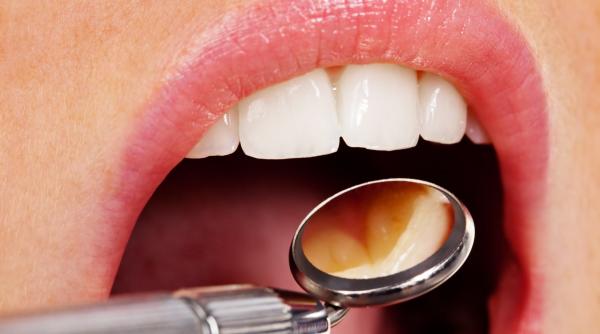 probleme dentare afecteaza inima creier tensiune