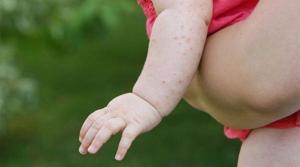 cazuri scarlatina boala contagioasa