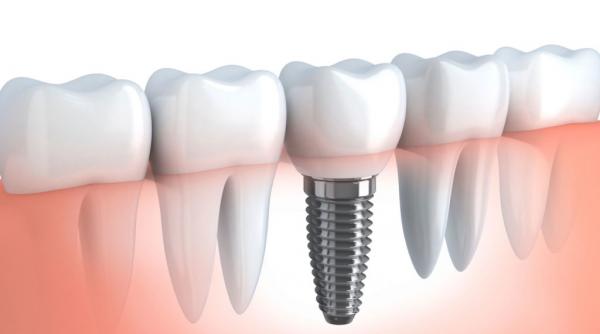 implant dentar demontare mit nu trebuie scos