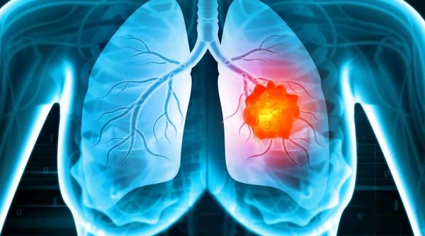 pacienti cancer pulmonar depresie
