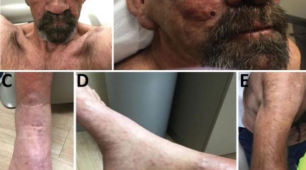 focar lepra florida mod de transmitere si simptome