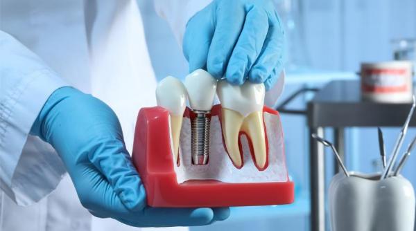 secretul zambetului radiant si accesibil implanturile dentare din titan