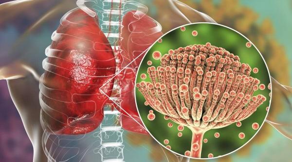 infectii boli fungice mortale nivel mondial