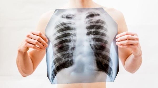 tuberculoza pacienti risc cancer