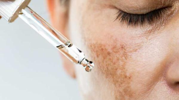 iuliana lupu cancer de piele melanom alunite