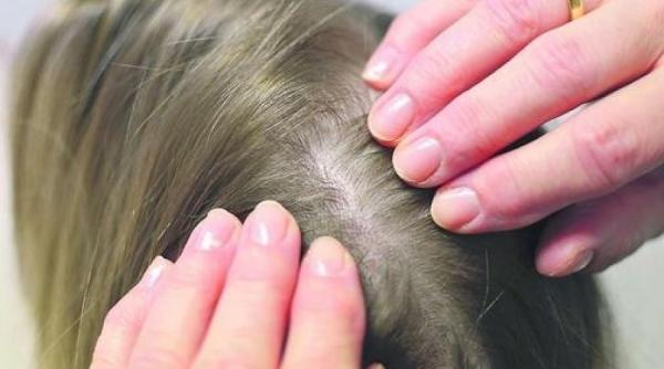 atentie la paduchii copilului preventie semne remedii naturale