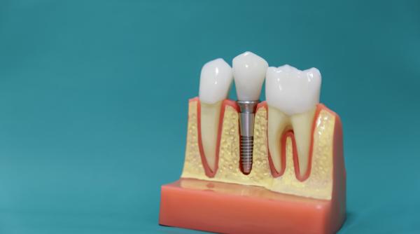 implantul dentar o procedura stomatologica de ultima generatie