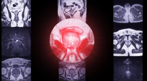 3 afectiuni ale prostatei care pot fi identificate cu ajutorul rmn ului