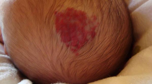 hemangiom copil cauze simptome tratament