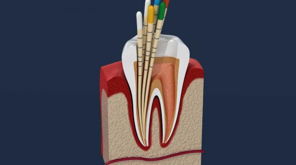 cele mai dureroase proceduri dentare statistici si sfaturi