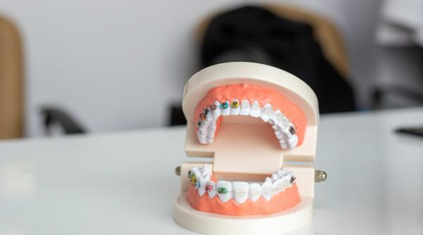 ce sa mananci si ce sa eviti cand porti aparat dentar