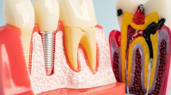 tot ce trebuie sa stii despre procedura de implant dentar pasi recuperare si pret