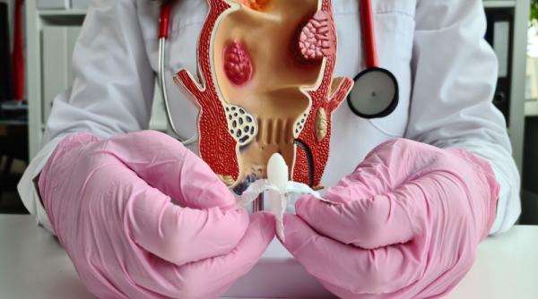 cum se folosesc corect supozitoarele pentru hemoroizi sfaturi si recomandari