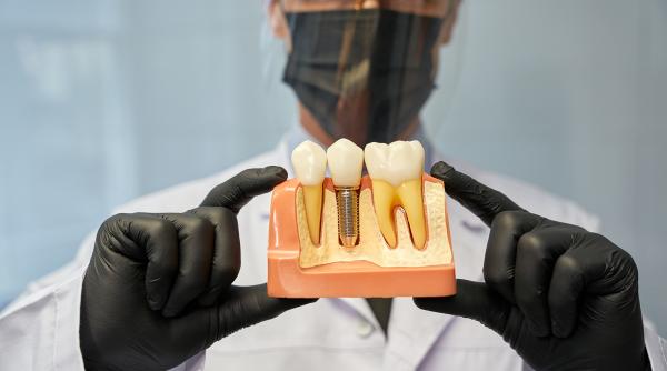 factori care afecteaza longevitatea implantului dentar