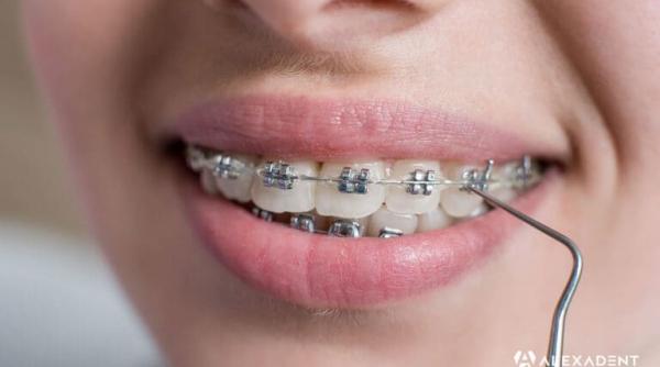 aparatele dentare invizibile tot mai populare printre adulti care sunt beneficiile lor