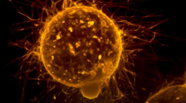 semne timpurii cancer piele danielle lloyd