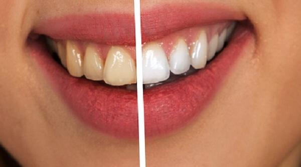 7 alimente evitat metode eficiente albire naturala dinti