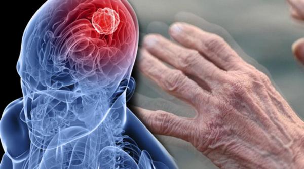 descoperire in medicina un test de sange ar putea detecta boala parkinson inainte de aparitia simptomelor