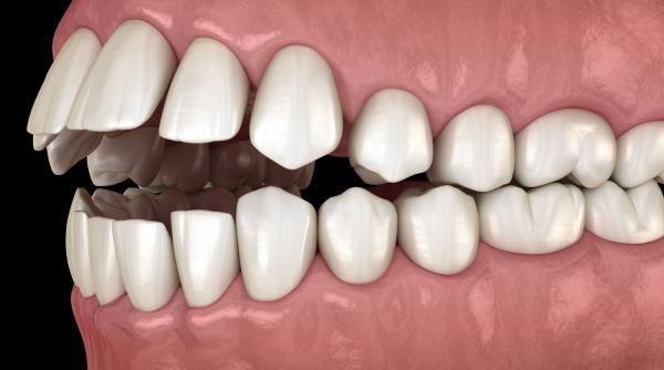 cum sa recunosti si cum se trateaza o muscatura deschisa