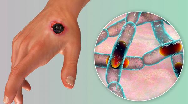 antrax boala tratament simptome coma