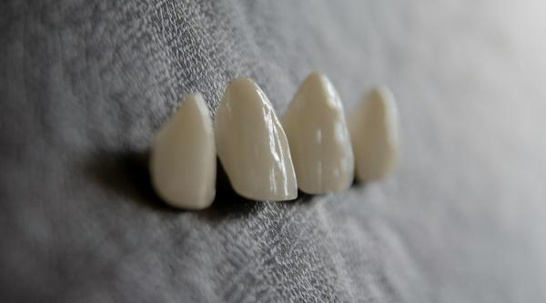 Tipuri de fatete dentare si avantajele acestora