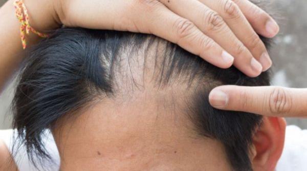 cand ingrijorezi caderea parului test simplu