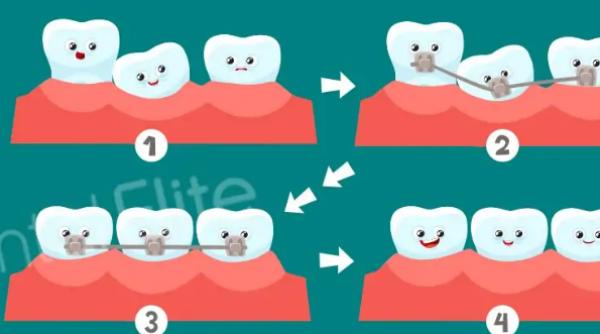 Zâmbetul pe care ți-l dorești: tehnici moderne de îndreptare a dinților