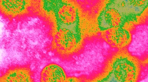 cancer colon principala cauza deces tineri sub 50 ani