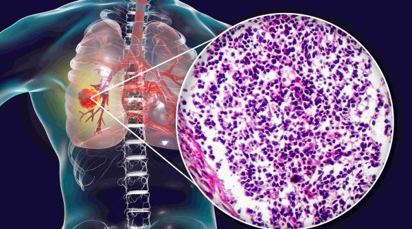 Un tratament nou pentru cancerul pulmonar agresiv primește undă verde în UE 
