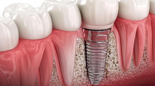 Când pacienții caută o soluție rapidă pentru o dantură stabilă și confortabilă