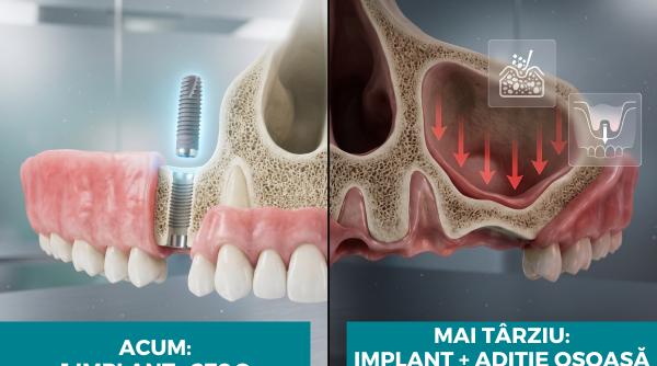 Cât te costă, de fapt, să nu îți pui implant dentar la timp?  