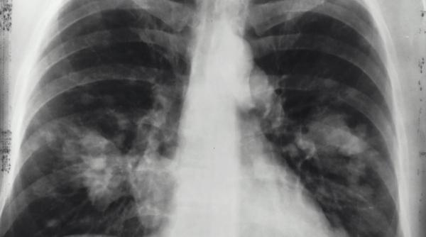 ingrijire pulmonara simptome cancer harta cabinete medicale romania