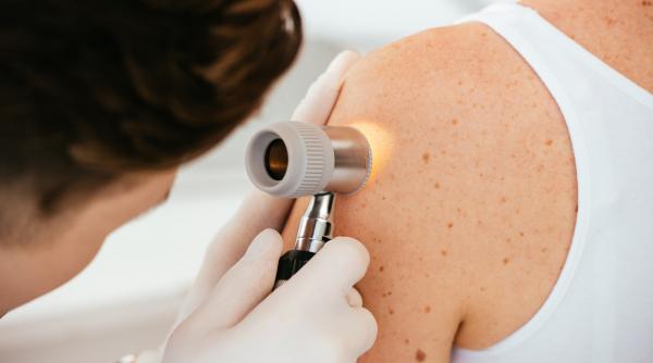 vara pericole piele raze uv zile noroase cancer