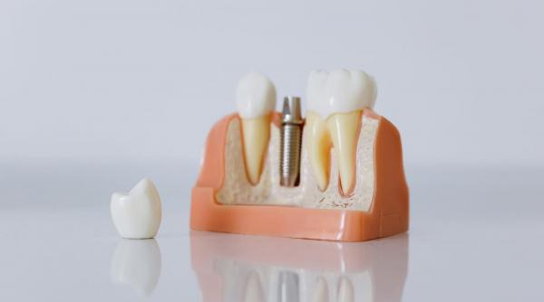 Implant premium vs implant economic: ce plătești în plus concret