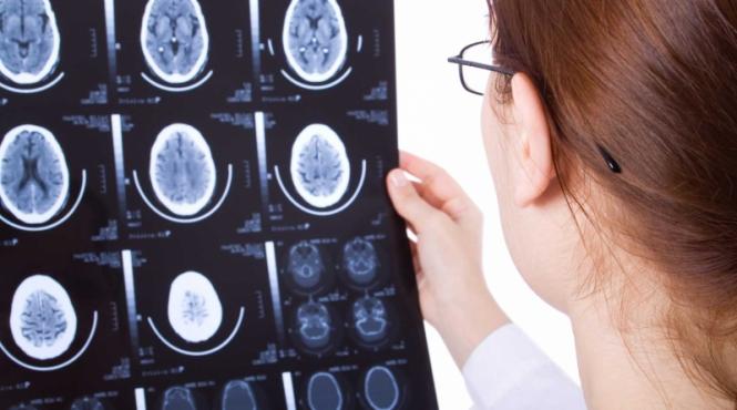 boala tacuta din creier