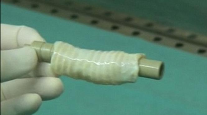 revolutie in medicina primul transplant al unui organ dezvoltat din celule stem prelevate de la pacient