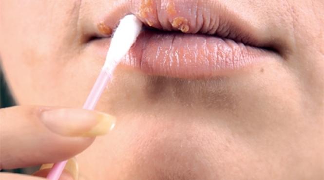 sase intrebari si raspunsuri despre herpes