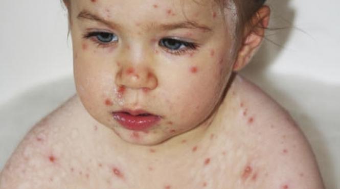 virusul adormit isi scoate coltii