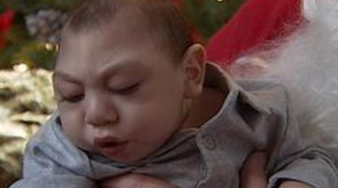 un copil nascut fara creier aniverseaza un an de viata