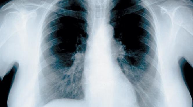 cancerul pulmonar nu se vede la radiografie