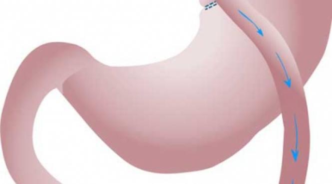 cu ce medicamente busim ulcerul