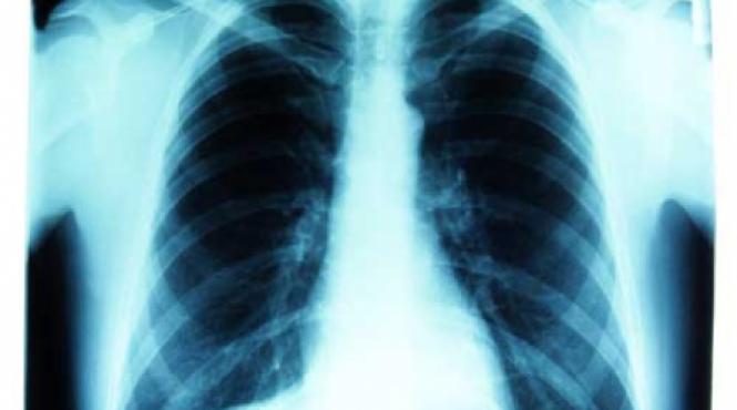 ce stim despre pneumonii