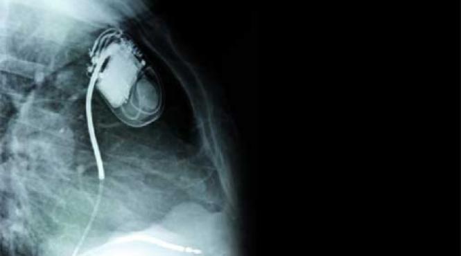 pacemakerul microtehnologia care bate cordul