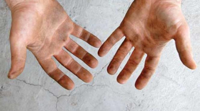 hepatita acuta se face pe picioare